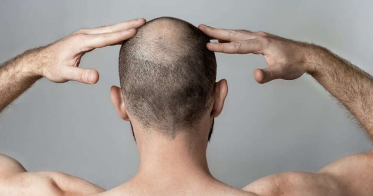 Depilación láser y medicación contra la alopecia